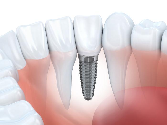 Why Dental Implants Are the Gold Standard for Replacing Missing Teeth
