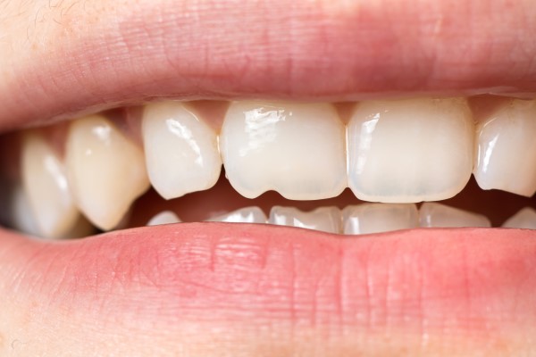 Same-Day Emergency Dental Care: What to Do If You Chip a Tooth