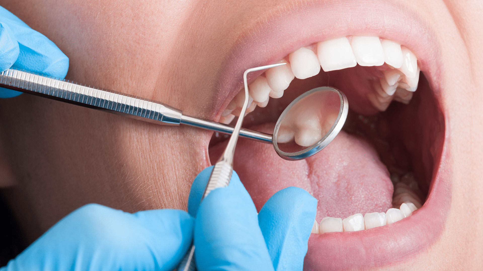 What Happens If You Skip Routine Dental Exams?