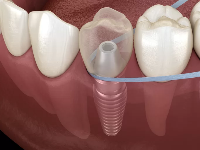 How to Care for Your Dental Implants