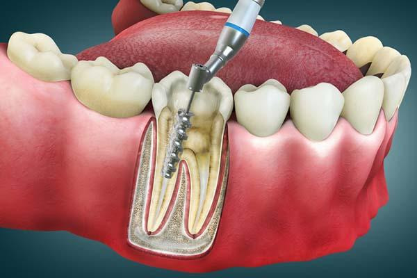 Does a Root Canal Hurt? What Patients Should Expect
