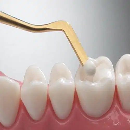 Everything You Should Know About Tooth-Colored Dental Fillings